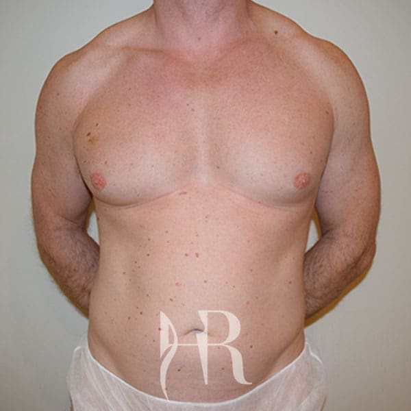 HR Plastic Surgery - Male Breast Reduction patient before 4